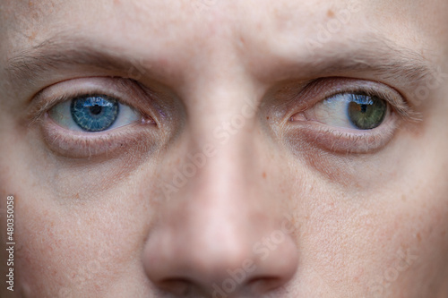 full face photo of a man with strabismus and blindness of one eye. visual disability photo