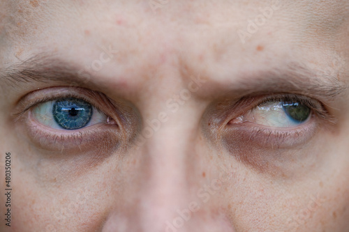 full face macro photo of a man with strabismus and blindness of one eye. visual disability photo