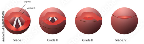 Cormack-Lehane system to assess the airway dificulty in intubation. Grade system to classifies laryngoscopy view. 