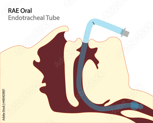 RAE Oral endotracheal tube for nose surgeries. Tube positioned to south, helping surgeon in nose surgeries. 