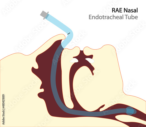 RAE Nasal endotracheal tube for mouth surgeries. Tube positioned to north, helping surgeon in mouth surgeries. 