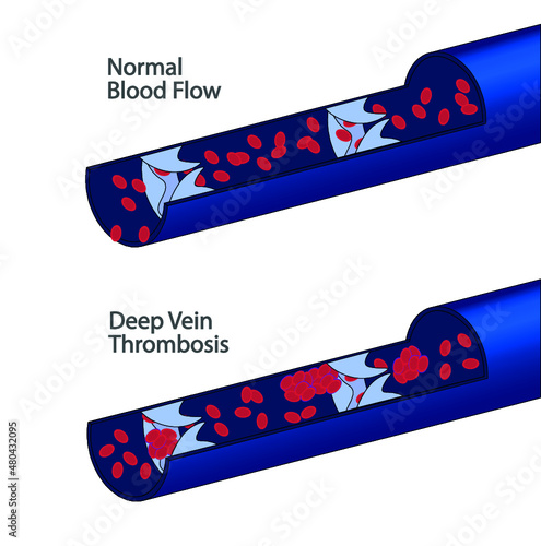 Deep Vein Thrombosis (DVT). Vein blood flow illustraion of a normal blood and with embolus.