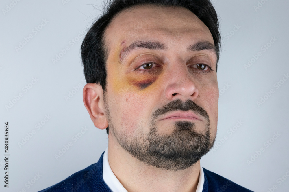 Obraz premium black eye after fall