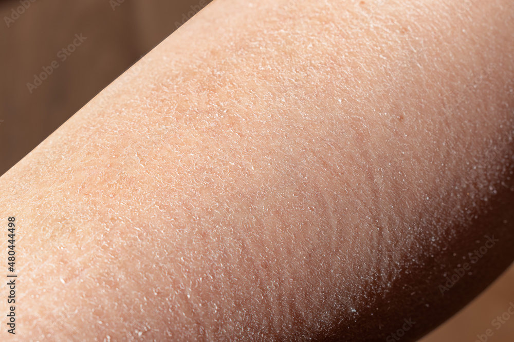 Concept of extremely dry and dehydrated skin of the body. Problem skin diagnosed with xerosi or dermatitis. Close up of chapped arms and legs. Selective focus of a itchy skin.