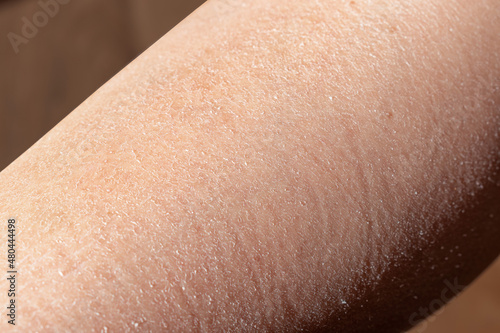 Concept of extremely dry and dehydrated skin of the body. Problem skin diagnosed with xerosi or dermatitis. Close up of chapped arms and legs. Selective focus of a itchy skin. photo