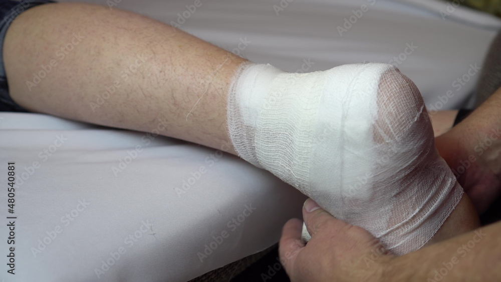 Ligation of the ankle joint with a bandage. Ligation of the ankle joint with a bandage.