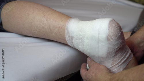 Ligation of the ankle joint with a bandage.