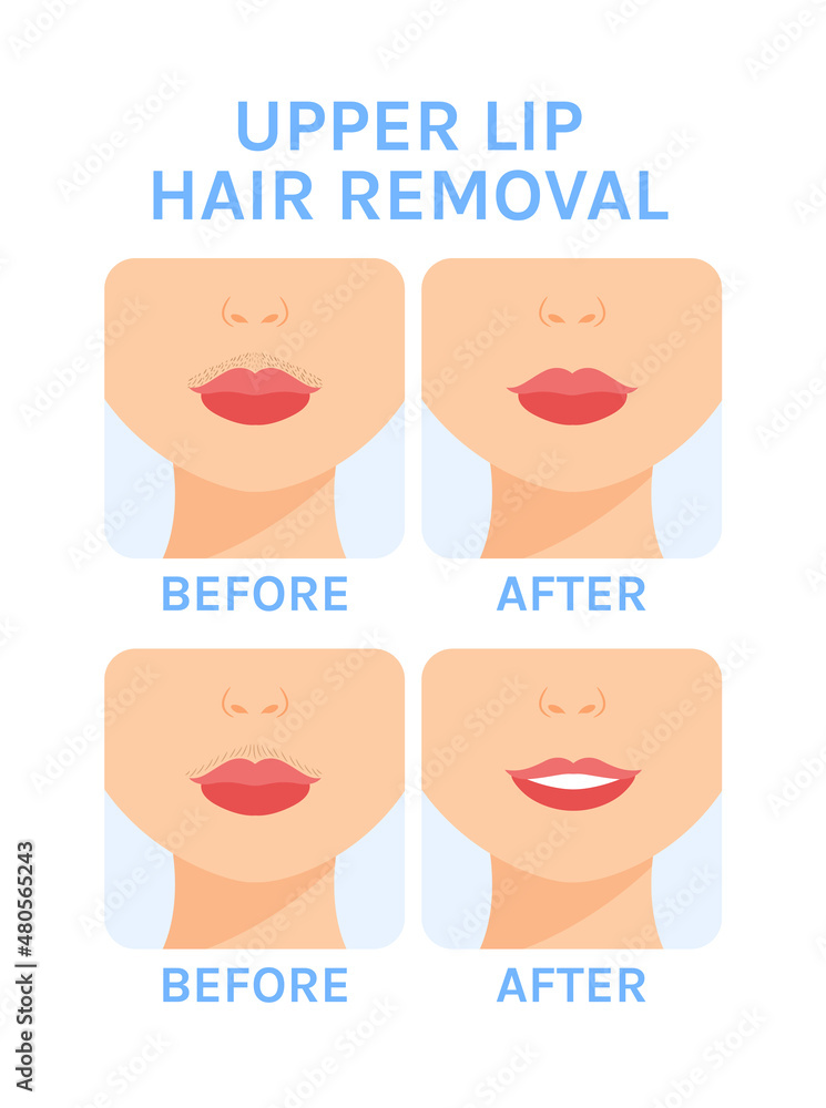 Hair on Upper Lip. Female Mustache. Depilation. Removal of Unwanted Hair  above Upper Lip. Before and After. Happy Female Part of Face. Smile.  Cartoon style. Vector illustration for Beauty Design. Stock Vector