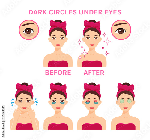 Dark Circles Under the Eyes. Beautiful Tired Woman. Treatment. Girl Washes her Face, Uses Eye Patches and Cucumbers. Before and After. Healthy Clean skin and a Happy Girl. Color Cartoon style. Vector.