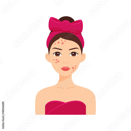 Beautiful Young Woman with Acne and Pimples on Face. Skin Problem. Pretty Brunette Girl in a Towel and with a Bow on Head. Color Cartoon style. White background. Vector illustration for Beauty Design.