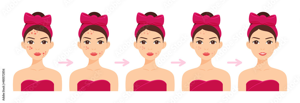 Cute Woman with Pimples on Face. Acne Treatment. Steps. Facial Skin Whitening. Stages. Happy Girl with a Smile and Clean Skin. Cartoon style. White background. Vector illustration for Beauty Design. Cute Woman with Pimples on Face. Acne Treatment. Steps. Facial Skin Whitening. Stages. Happy Girl with a Smile and Clean Skin. Cartoon style. White background. Vector illustration for Beauty Design.