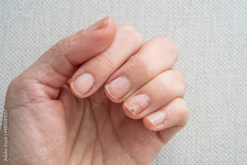  nail fungus infection on hand finger of white woman