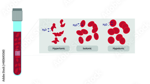 Human cell osmosis. Hemoglobin in a isotonic, hypertonic and Hypotonic illustration 