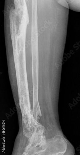 x ray of a osteomyelitis cruris 