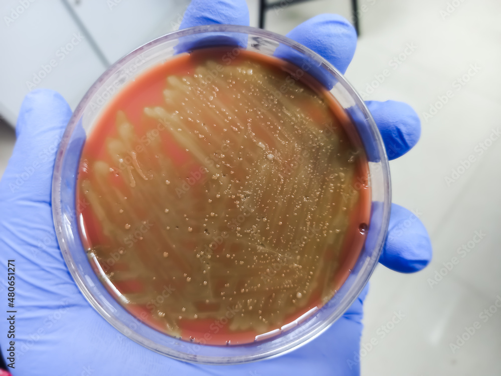 Mixed colony in Chocolate agar media, Stresptococcus colonies, Gram