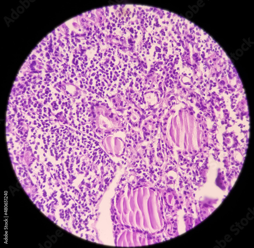 Thyroid gland(biopsy): Nodular goitre and lymphocytic thyroiditis, show thyroid follicles with cystic change, no malignancy seen, 40x focus view. photo