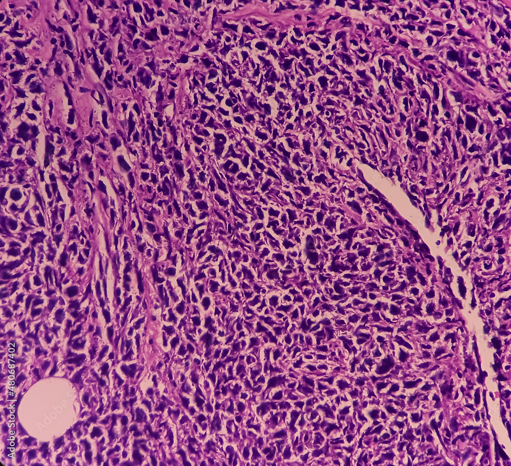 Microscopic image of Colorectal carcinoma and Amelanotic melanoma. Show