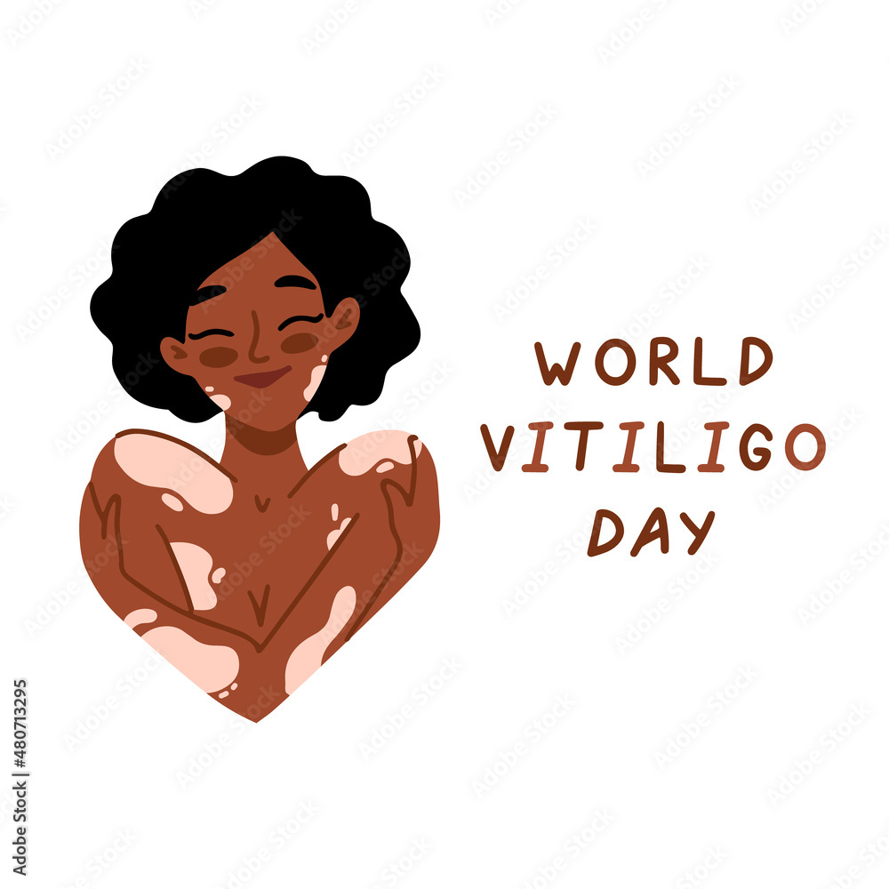 World Vitiligo Day. Young african american woman with vitiligo. Support people with chronic skin disorder. Beauty is diversity. Self acceptance, self love concept. Poster, banner, card