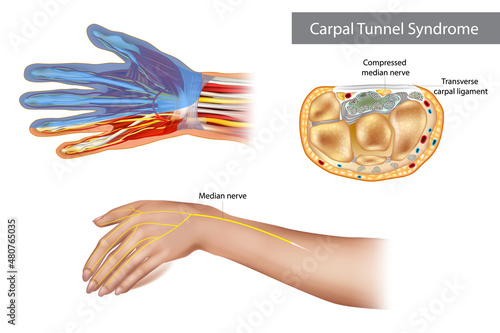 Carpal tunnel syndrome. Compressed median nerve. Anatomy of the carpal tunnel, showing the median nerve.