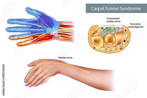 Carpal tunnel syndrome (CTS). Compressed median nerve. Anatomy of the carpal tunnel, showing the median nerve. 