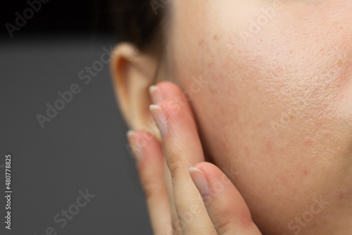 Wallpaper Mural Closeup of acne-prone skin with scarring and post-inflammatory erythema after isotretinoin treatment. Torontodigital.ca