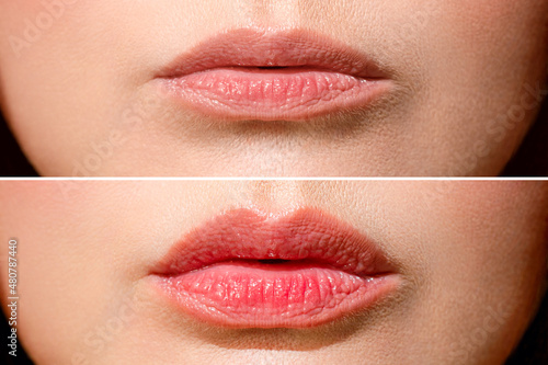 Result before and after lip shaping. A woman makes lip shape correction in a cosmetology clinic. Lip injections, lip augmentation.