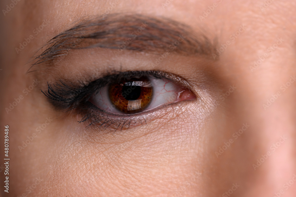Obraz premium Disease of retina of the eye. Close-up of female eye with red inflamed and dilated capillaries.