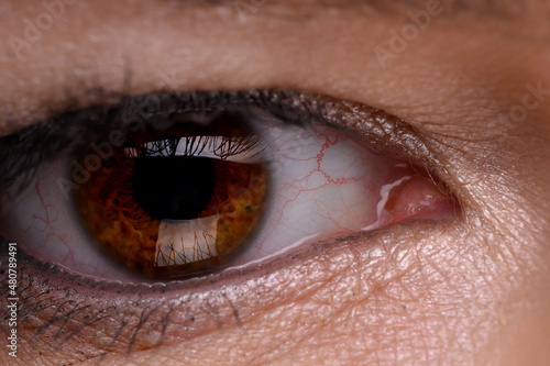Disease of retina of the eye. Close-up of female eye with red inflamed and dilated capillaries. photo