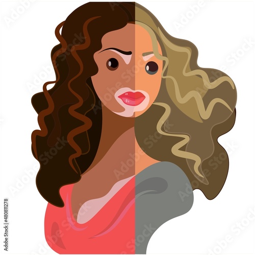 Vitiligo in two young women of different races, different skin colors with skin problems. One portrait, two in one. World Vitiligo Day concept. Vector isolated flat style for blogs, articles, web.