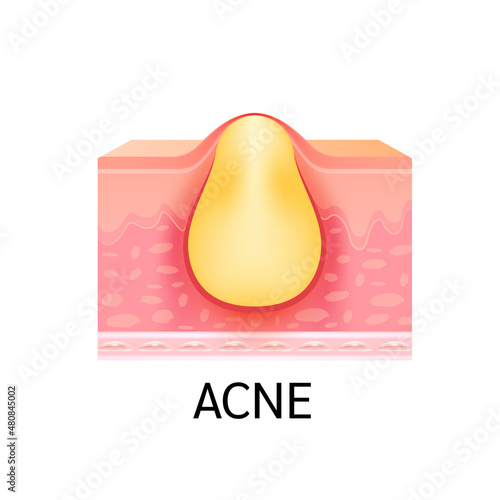 Formation of skin acne or pimple. Anatomy of skin. Medical beauty skin care concept. On a white background. 3D vector.
