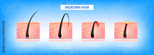 Ingrown hair. Hair has grown back into the skin surface after shaving. Formation of skin acne or pimple. Anatomy infographics of hair and skin. 3D vector illustration.