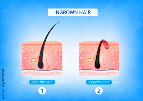 Ingrown hair. Hair has grown back into the skin surface after shaving. Formation of skin acne or pimple. Anatomy infographics of hair and skin. 3D vector illustration.