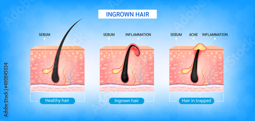 Ingrown hair. Hair has grown back into the skin surface after shaving. Formation of skin acne or pimple. Anatomy infographics of hair and skin. 3D vector illustration.