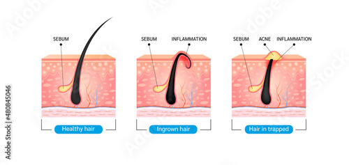 Ingrown hair. Hair has grown back into the skin surface after shaving. Formation of skin acne or pimple. Anatomy infographics of hair and skin. On a white background. 3D vector illustration.