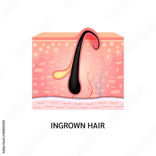 Ingrown hair. Hair has grown back into the skin surface after shaving. Formation of skin acne or pimple. Anatomy infographics of hair and skin. On a white background. 3D vector illustration. photo