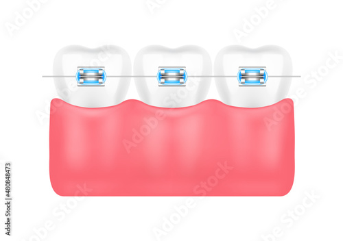 Orthodontic treatment style fashion beautiful blue. White teeth with metal brackets. Tooth braces isolated on a white background. Realistic 3D vector. Dental care health concept.