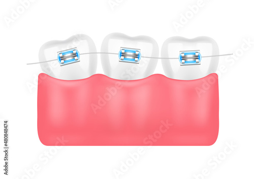 Orthodontic treatment style fashion beautiful blue. White teeth with metal brackets. Tooth braces isolated on a white background. Realistic 3D vector. Dental care health concept.
