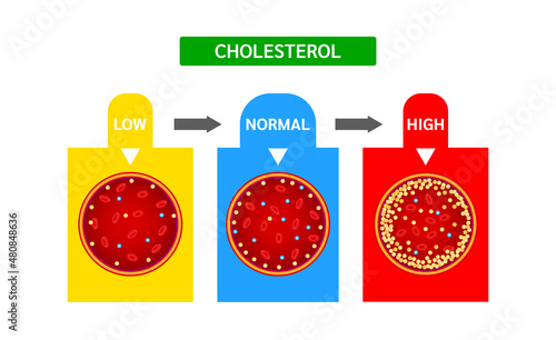 Cholesterol meter or scale comparison with HDL High density lipoprotein and LDL Low density lipoprotein. Normal blood flow and Cholesterol artery thrombosis disease. ​​Medicine and health Vector.