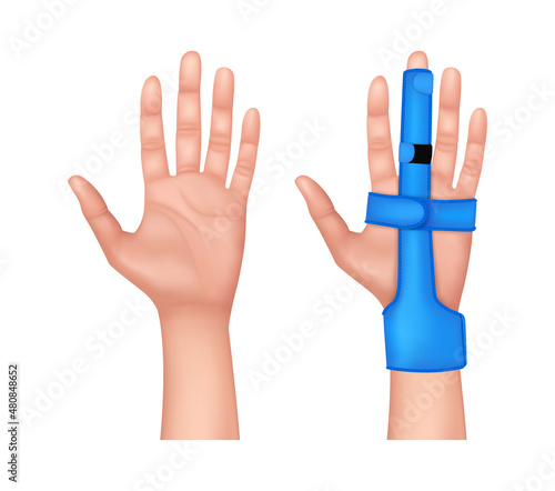 Plastic two sided finger splint with two convenient hook and loop straps on an broken middle finger. Holding a finger straight with orthopedic tool. isolated on white background. 3D vector EPS10.
