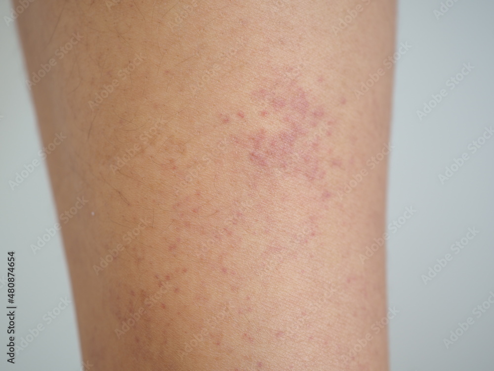 Patients with thrombocytopenia until the bleeding under the skin as red blood spots spot on the leg. closeup photo, blurred. Patients with thrombocytopenia until the bleeding under the skin as red blood spots spot on the leg. closeup photo, blurred.