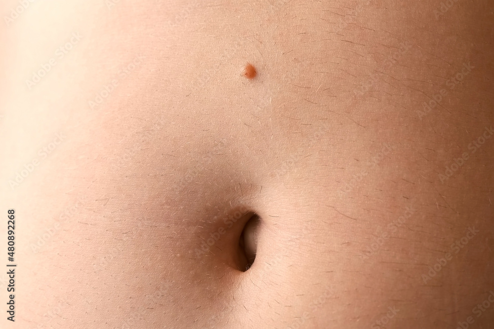 Large protruding mole wart on the man's stomach above the navel, closeup view. Human body with brown mole on tummy. Laser surgery, a one-day operation. Large protruding mole wart on the man's stomach above the navel, closeup view. Human body with brown mole on tummy. Laser surgery, a one-day operation.