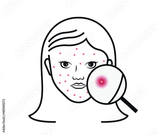 skin with acne problem. The theme of cosmetology, medicine, dermatology. Acne infographic, irritated problem skin concept.