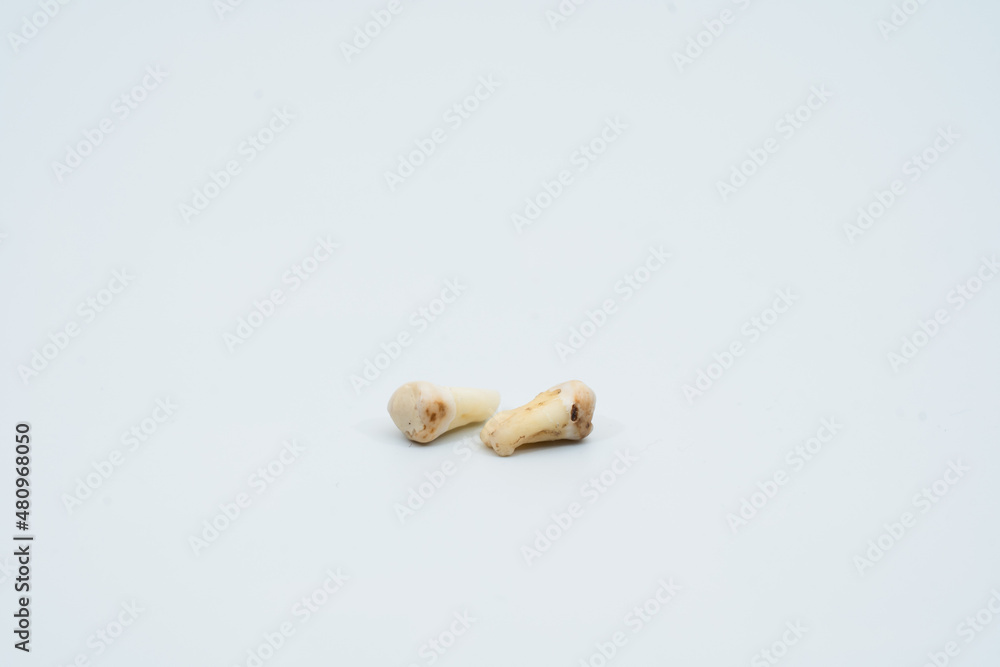 Human teeth caries on white background Human teeth caries on white background