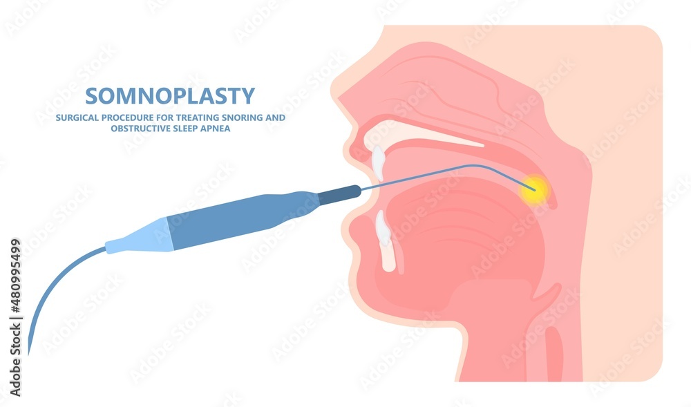 Uvula Incision UPPP laser assisted sleep apnea OSA surgery treat tonsil uvula Uvulo ...