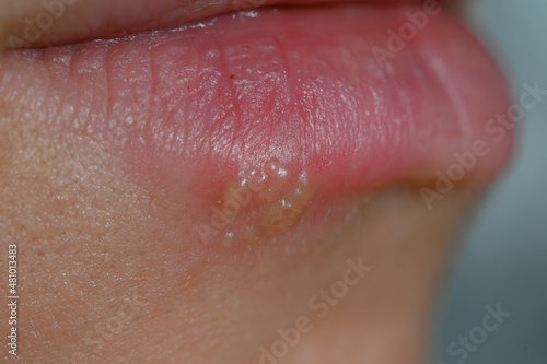 Macro photography of female lips suffering from herpes. Pimples on lower lip. Common cold virus herpes. Concept of healthcare
