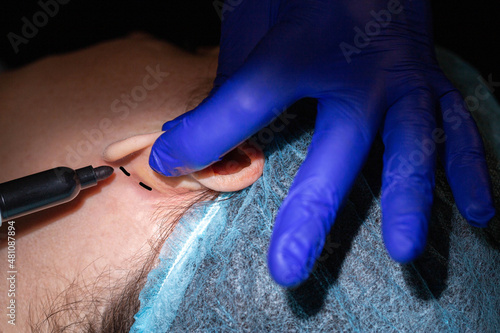 Canvas Print A plastic surgeon performs an operation to correct the ears of a female patient
