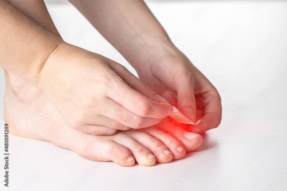 A woman glues a plaster for the treatment of calluses and calluses to