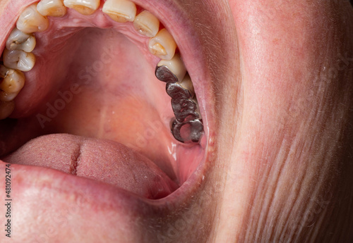 Photos Old metal crowns in the patient's mouth on the chewing teeth