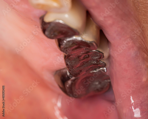 Tableau sur toile Metal crowns on the teeth in the mouth of a woman