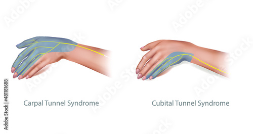 Medical illustration of the Cubital and Carpal Tunnel Syndrome. Compressed Median and  Ulnar nerve. Vector